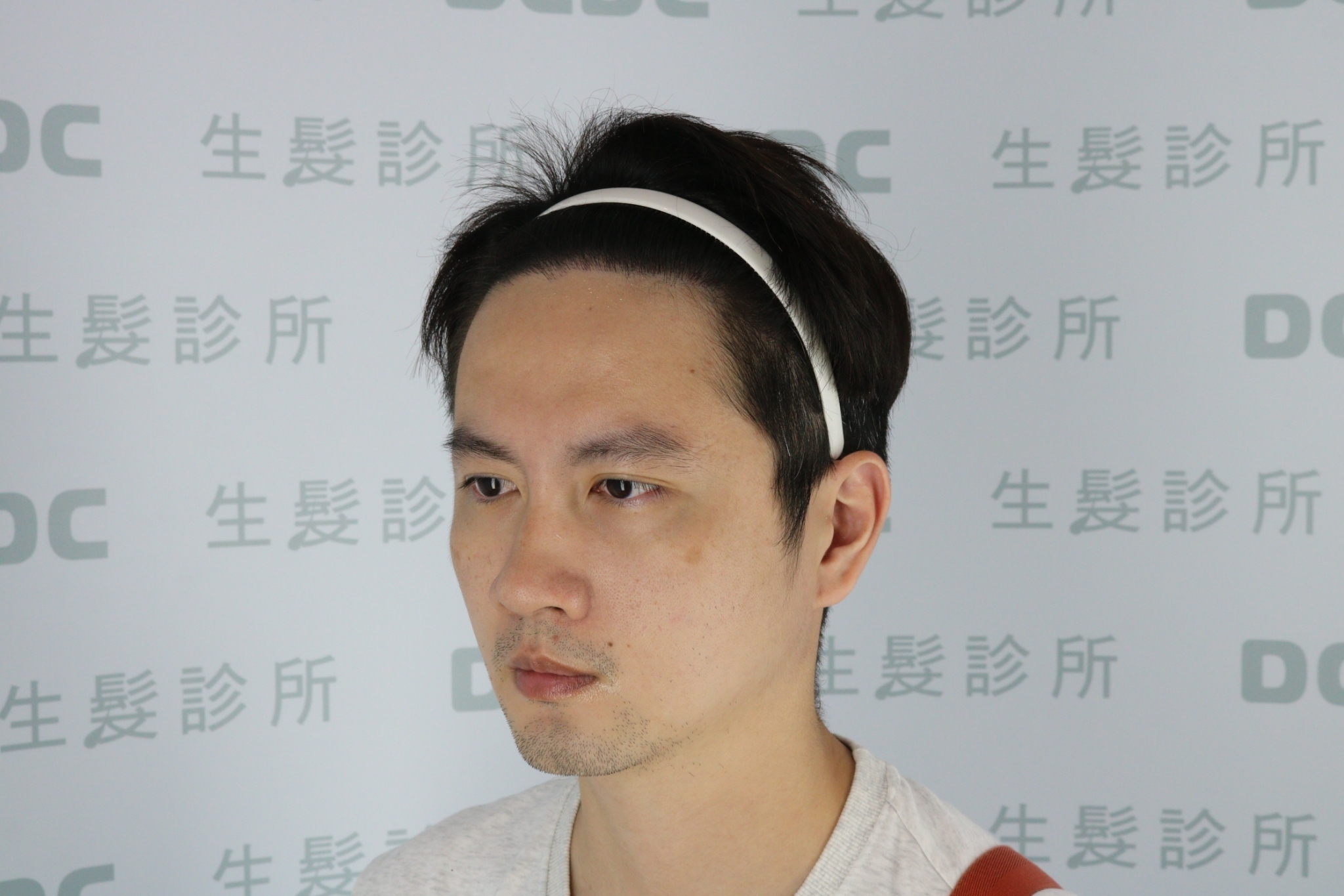 DCDC生髮診所-男性美型髮際線重建術後9個月俐落輪廓成果